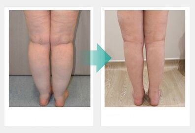 Results of using Marilyn's Motion Energy gel (before and after)