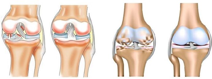 What is arthritis and arthritis 